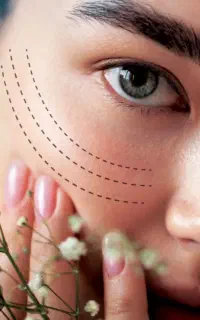 فیلر ، ژل ، بوتاکس