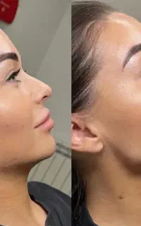 تخفیفات 50درصدی کوچک کردن بینی/ژل/بوتاکس/انزیم