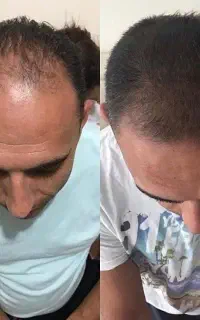 شروع دوباره رشد مو از ریشه