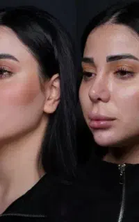ژل بوتاکس فیلر چشم لب گونه مزوتراپی فشیال خانم اقا