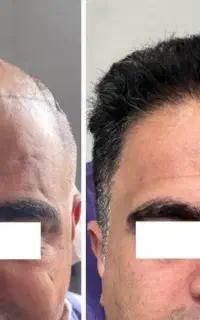 کاشت مو با قیمت پارسال مدت محدود