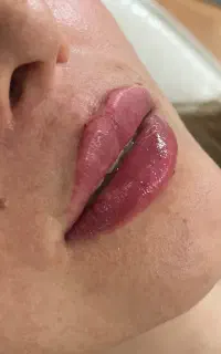 ژل لب و بوتاکس
