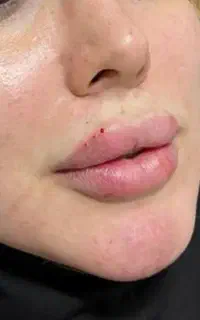 ژل بوتاکس مزو ژل