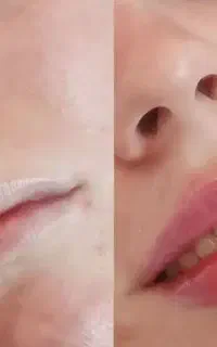 خدمات فیلر و بوتاکس