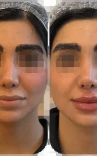 بوتاکس پیشانی - دکتر مریم هلاکو