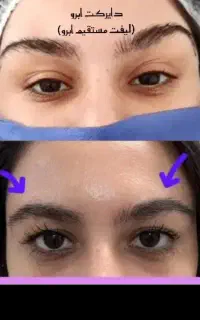 دایرکت .تزریق وتخلیه چربی .بلفارو