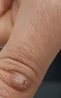 الکترولیز موی سفید وبرداشتن خال و زگیل ومیخچه