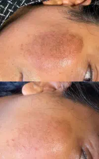 لیزر روشن سازی و پاکسازی بدن و صورت