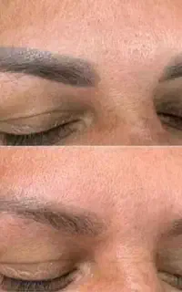 ریموو تک‌جلسه ای(پاک کردن تتو ابرو،لب و چشم )