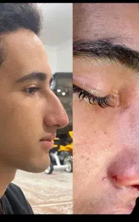 جراحی بینی/رینو پلاستی