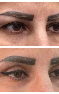 جراحی پلک بالاوپایین توسط متخصص .باتجربه بالا