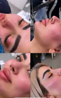 جشنواره ژل و بوتاکس مزوژل و فیلر بادی