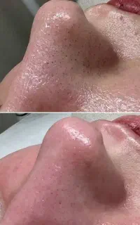 تخفیف ویژه پاکسازی پوست فشیال