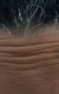 بوتاکس