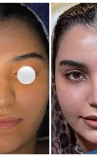 عمل جراحی بینی لیزری بدون کبودی/فوق تخصص/لیپو/لیفت