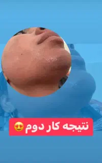 لیزر موهای زائد با هدیه یه عدد عطر