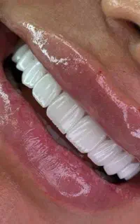 کامپوزیت طبیعی اقساطی