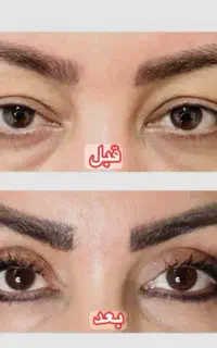 عمل رفع افتادگی پلک بلفارو پلاستی با هوش مصنوعی