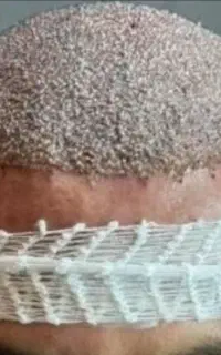 کاشت مو. و ابروی پر تراکم و نچرال (آوین کاشت )