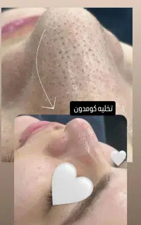 پاکسازی پوست ۵۰درصد تخفیف