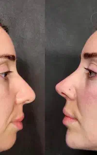 تغییر شکل بینی بدون عمل جراحی