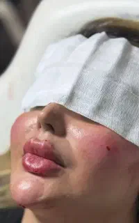 فیلر لب فقط1/200،بوتاکس،فیلرباسن،بیکینی