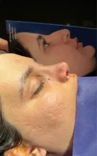 عمل بینی( پیزو)
