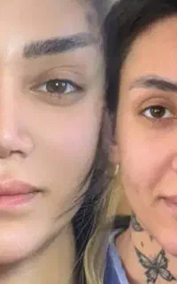 مینی لیفت شقیقه گونه اندولیفت ابروبلفارو