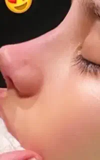 تخفیف عیدانه جراحی بینی