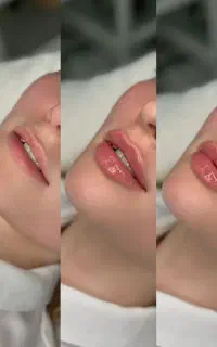 نیازمند مدل تزریق فیلر فقط هزینه مواد، توسط پزشک