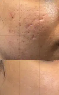 بوتاکس فیلر لب