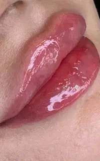 انجام تمام خدمات زیبایی تزریق بوتاکس و فیلر و..