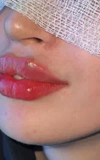 تزریق بوتاکس فیلر ژل نوین لوتوس