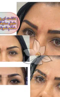 تخفیف فوق العاده کاشت ابرو/مو