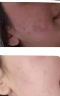 آموزش تکنیک های فشیال  حرفه ای