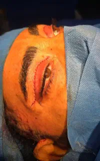 جراحب غبغب و پلک و لیفت صورت  تخفیف ویژه تعطیلات