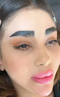 ژل و بوتاکس و پرسینگ و چال گونه
