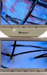 تخفیف استثنایی اسکراب اسکالپ (پاکسازی کف سر)