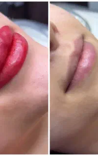 میکروبلیدینگ ،شیدینگ لب