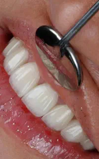 درمانی کامپوزیت ایمپلنت با شرایط ویژه