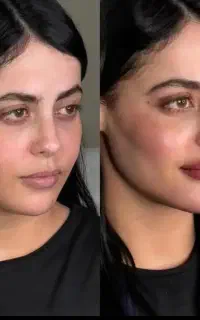 تزریق چربی صورت ،بیکینی ،سینه و دست و پا