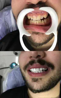 کامپوزیت دندان فکی ۱۸