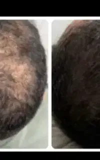 کم تر از ۳۰ روز موهاتو پر پشت کن