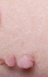 رفع صد درصدی hpv