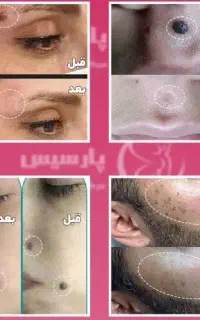 پلاسماوفیان مزو نیدل و کرم پودر دائم