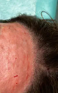 جشنواره تزریق بوتاکس و پی آر پی(prp) و سابسیژن