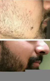 رویش ریش وسیبیل
