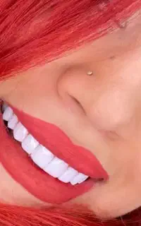 کامپوزیت ونیر زیبایی دندانپزشکی صدفی سرامیکی شیشه