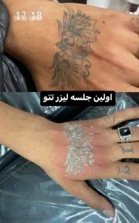 دستگاه پیکوشور با نتایج ماندگار