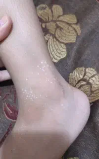 با لک ها و سوزش و خارش هات خداحافظی کن